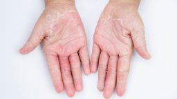 5 Wonderfully Natural Remedies to Fight Dry Skin